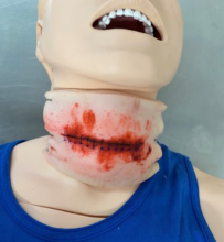 Neck Haematomas 